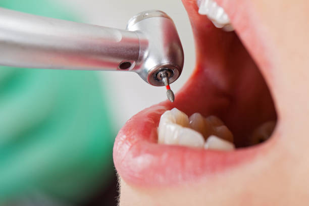 Best Emergency Dentist for Lost Fillings or Crowns in Westmont, IL